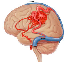 Как артериовенозные мальформации повреждают головной и спинной мозг